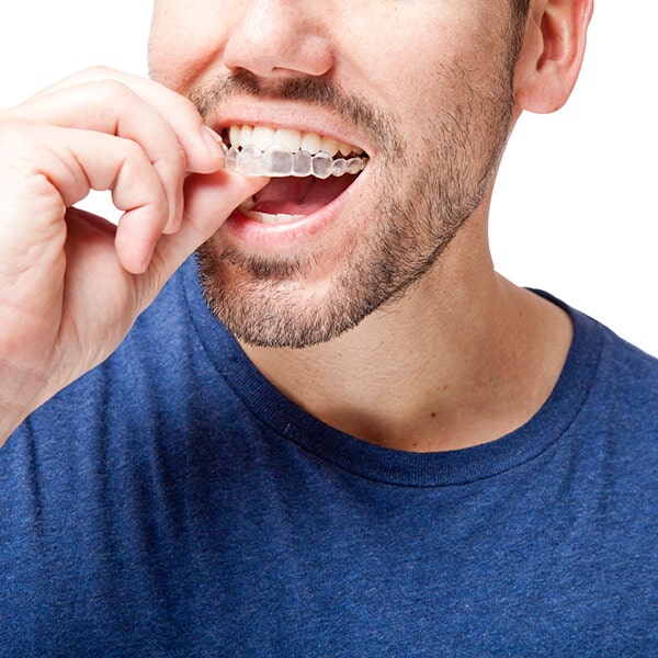 A young man putting an invisalign on his mouth
